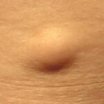 lipoma
